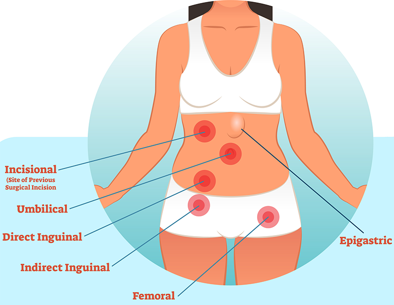 This stylised graphical image shows a female torso with pointers to illustrate where the different types of hernias can be experienced. It shows the position of Incisional, Umbilical, Inguinal, Femoral and Epigastric hernias.