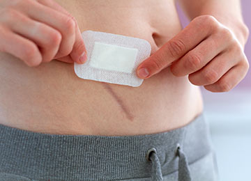 A photo showing a dressing being applied to a closed and healing hernia wound