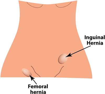 This basic graphical image shows the position of the types of groin hernia - Inguinal and Femoral.