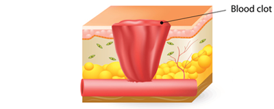 Image 1 of 4 representing the four stages of wound healing - bleeding