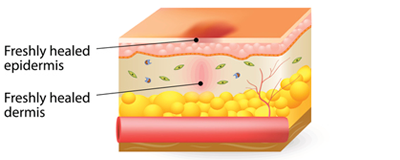 Image 4 of 4 representing the four stages of wound healing - remodelling