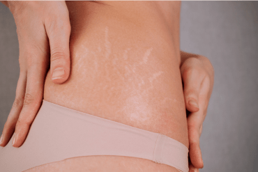 Alimentation et exercices pour réduire la cellulite