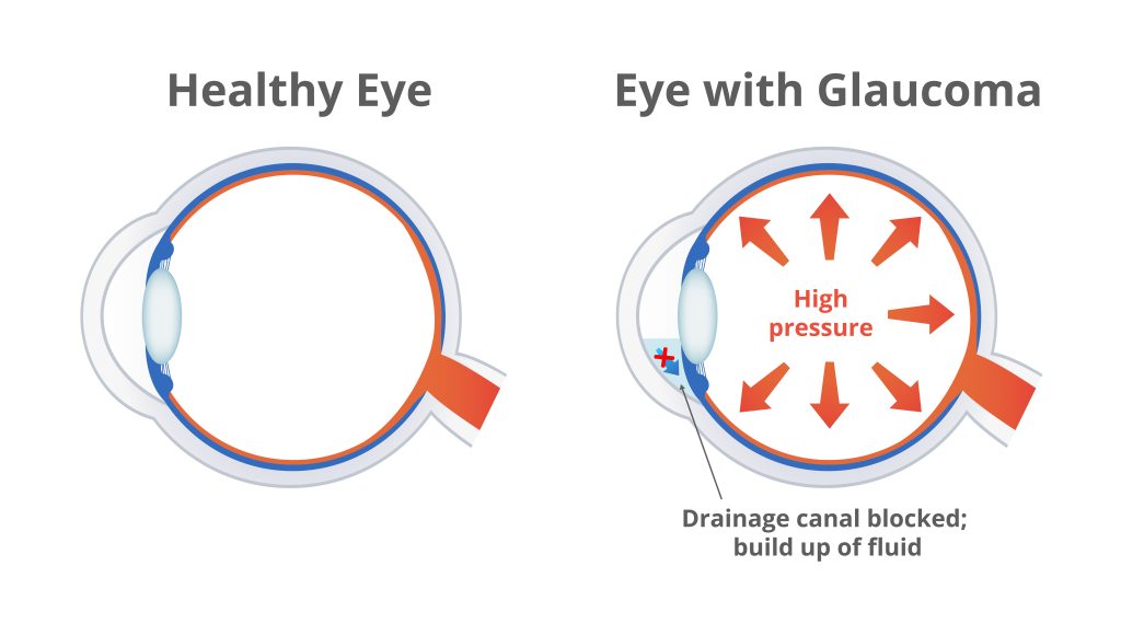 Comparison of a damaged eye with glaucoma and normal healthy eye isolated on white.