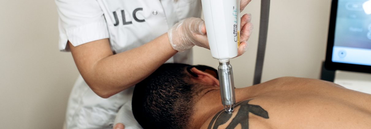 Tatoeage verwijderen Behandeling JLC Amsterdam