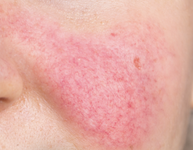 rosacea behandeling amsterdam