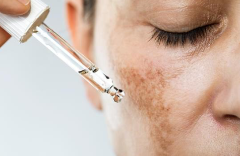 melasma behandeling amsterdam