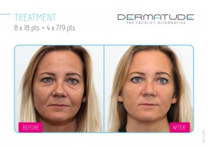 Dermatude, the Facelift Alternative