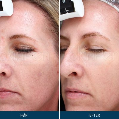 Microneedling SkinPen Kampagne 2 Microneedling SkinPen før og efter 2