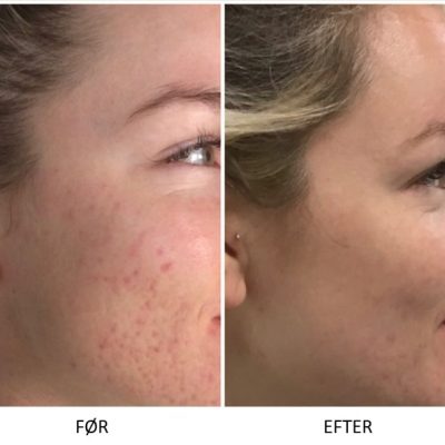 Microneedling SkinPen Kampagne 12 Microneedling SkinPen før og efter 10