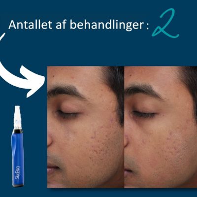 Microneedling SkinPen Kampagne 11 Microneedling SkinPen før og efter 11