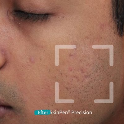 Microneedling SkinPen Kampagne 13 Microneedling SkinPen før og efter 12