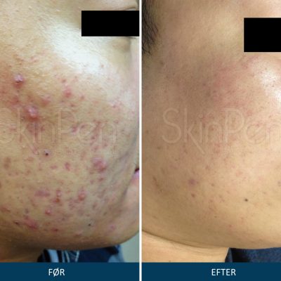 Microneedling SkinPen Kampagne 3 Microneedling SkinPen før og efter 3