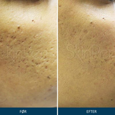Microneedling SkinPen Kampagne 4 Microneedling SkinPen før og efter 4