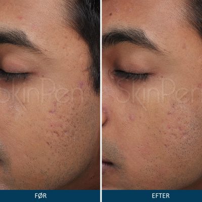 Microneedling SkinPen Kampagne 6 Microneedling SkinPen før og efter 5