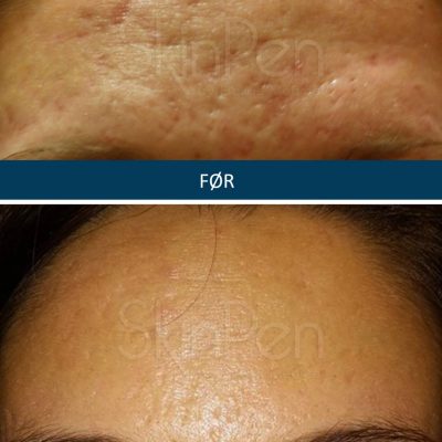 Microneedling SkinPen Kampagne 7 Microneedling SkinPen før og efter 6