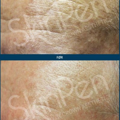 Microneedling SkinPen Kampagne 9 Microneedling SkinPen før og efter 8