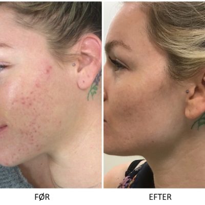 Microneedling SkinPen Kampagne 10 Microneedling SkinPen før og efter 9