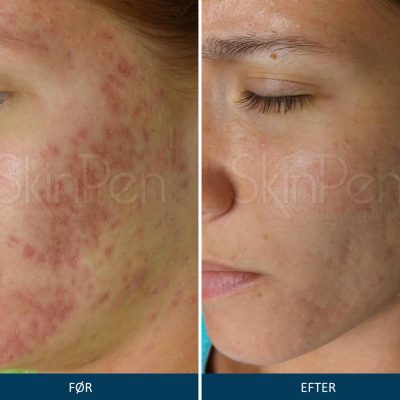 Microneedling SkinPen Kampagne 5 Microneedling SkinPen før og efter