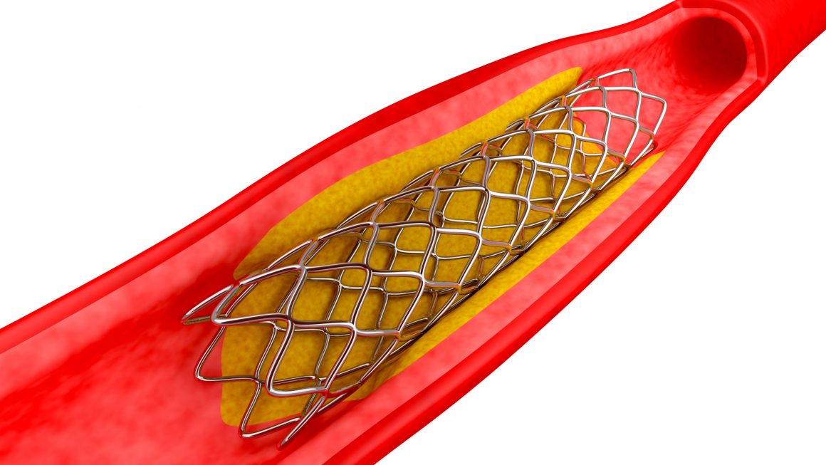 Stent apo Bypass