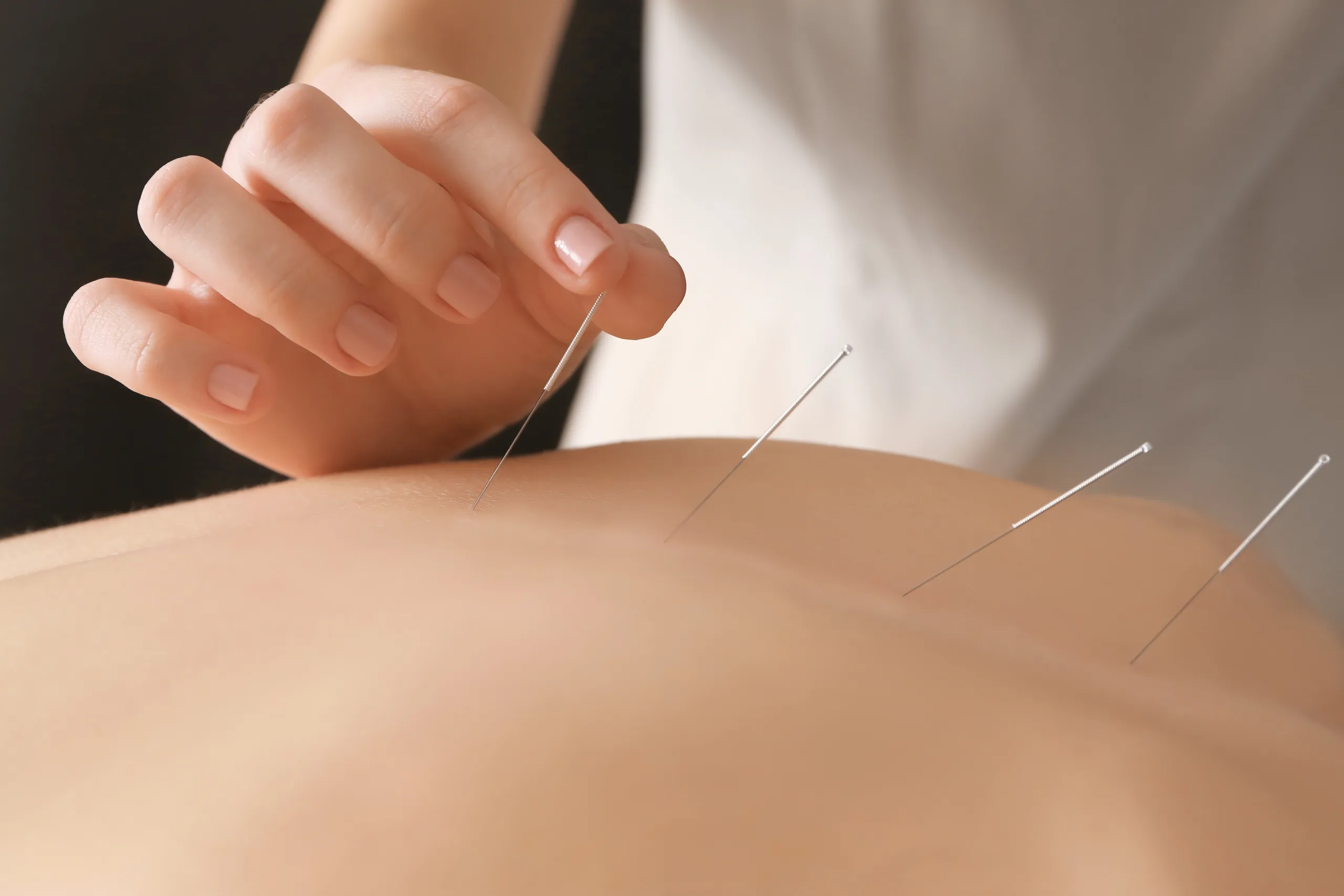 Akupunktur i ryg