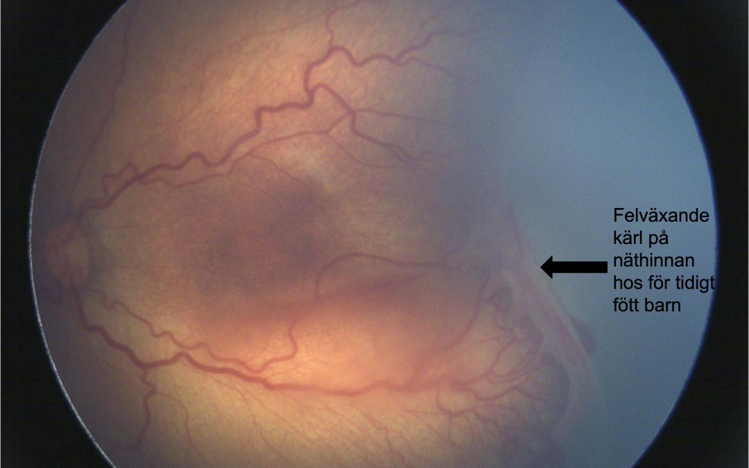 Retinala tillstånd hos prematura barn