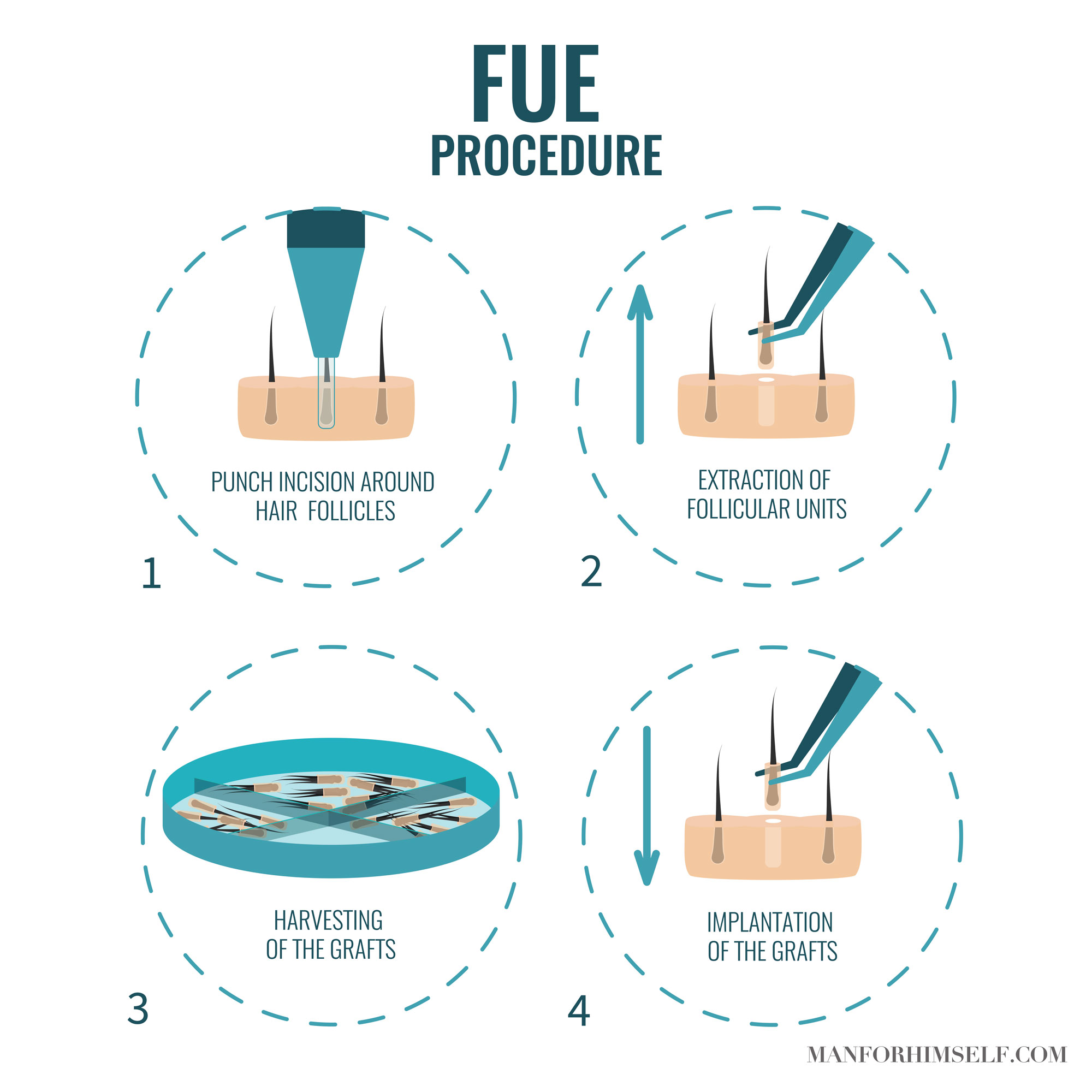 FUE-HAIR-TRANSPLANT-GRAPHIC