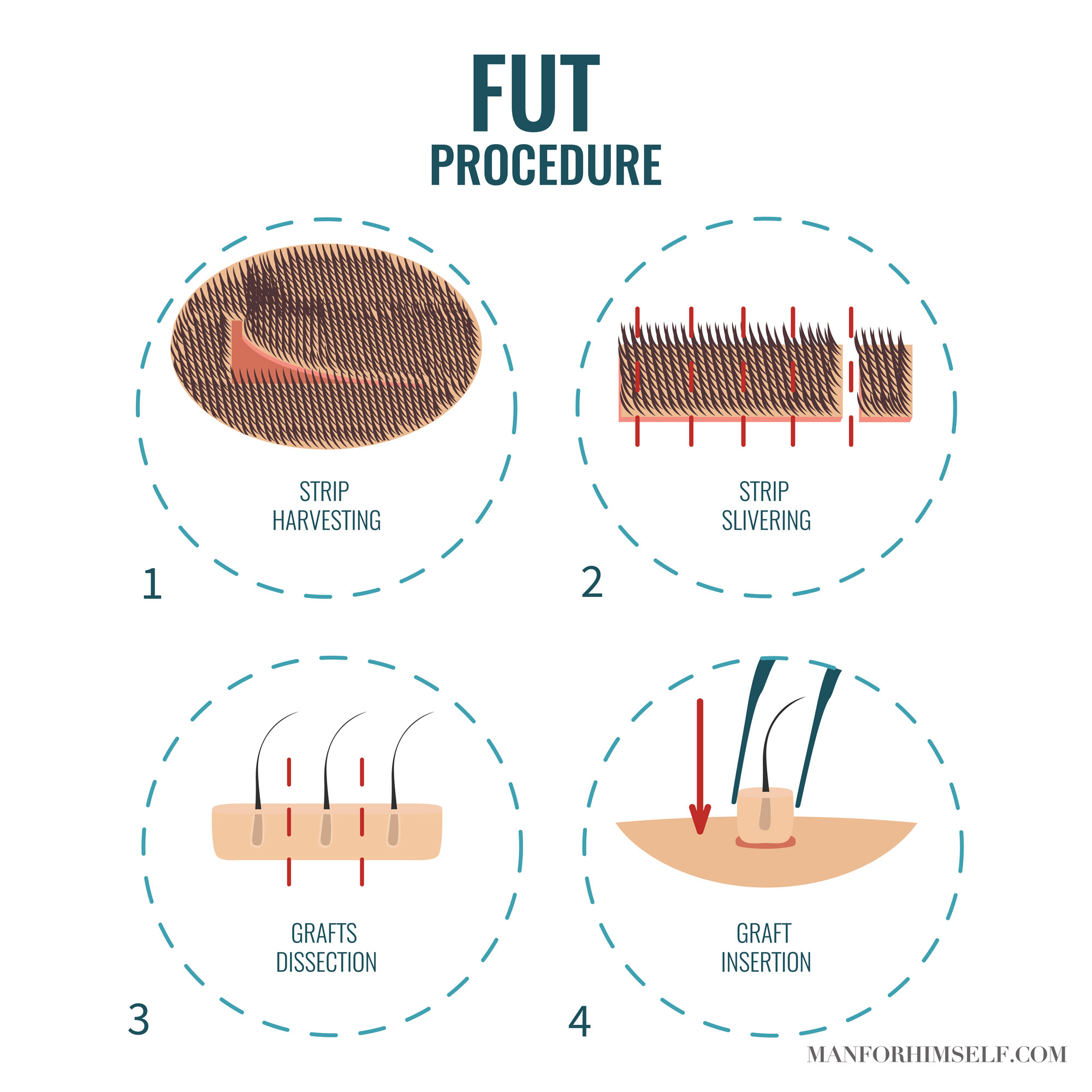 FUT-HAIR-TRANSPLANT-GRAPHIC