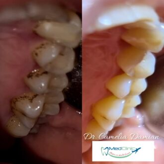 Protetica - Proteza Imediata Post-Implantara