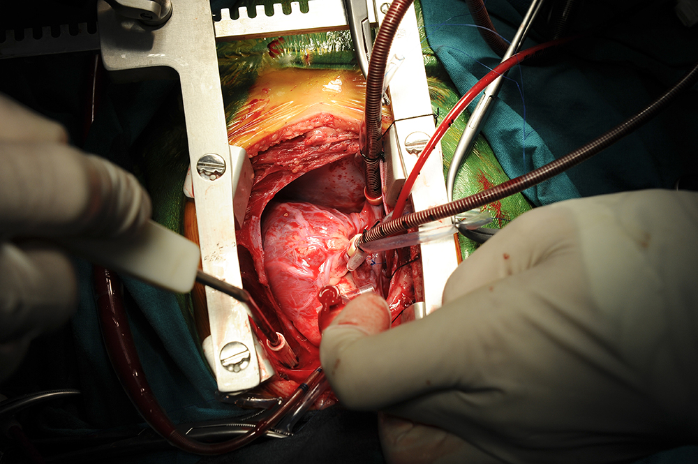 Pediatric heart surgery, close-up