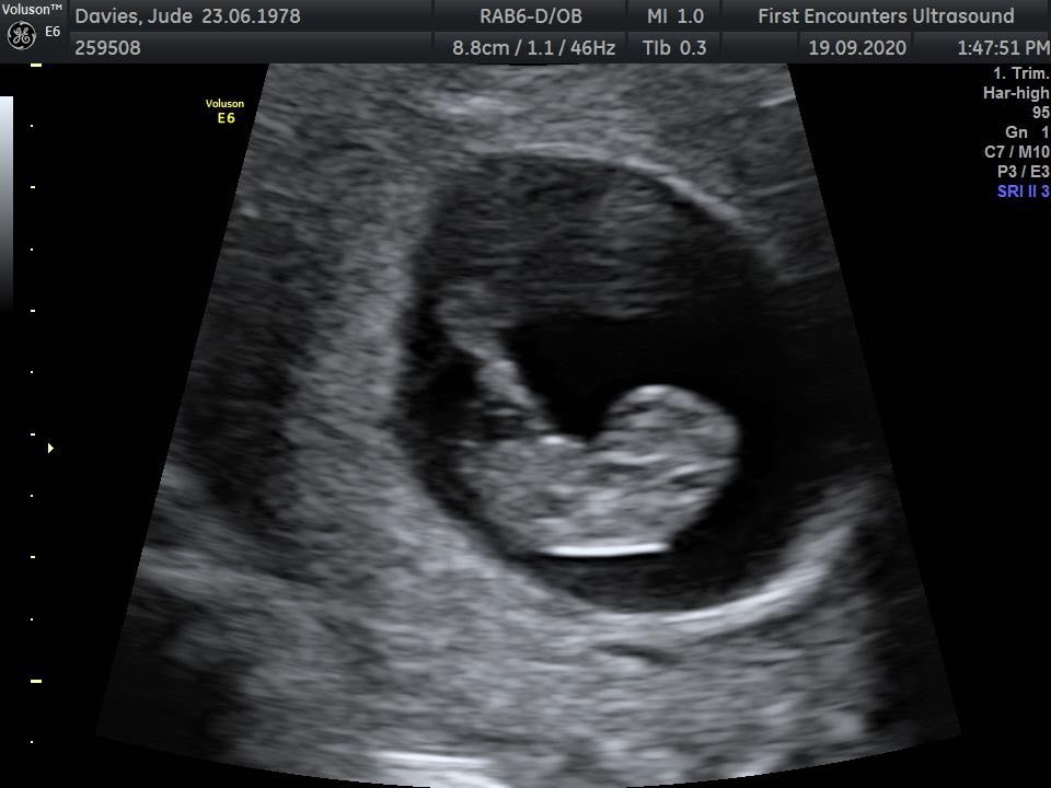 Scan image of a baby