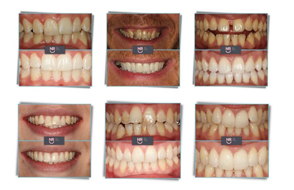 invisalign bromsgrove