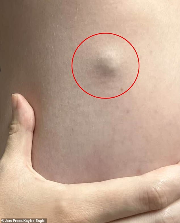 Engle said lumps like the one shown began appearing all over her body. Urgent care doctors first told her they were likely benign cysts. But her ongoing nausea and fatigue led her to the hospital for further testing