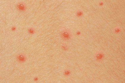 Chicken Pox