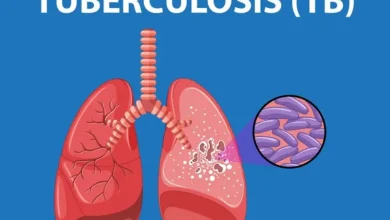 Tuberculosis