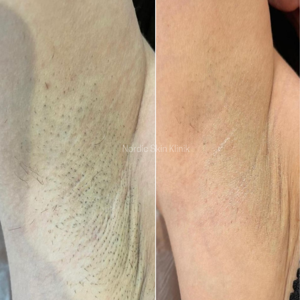 Laser hairremoval treatment results of a woman's armpits