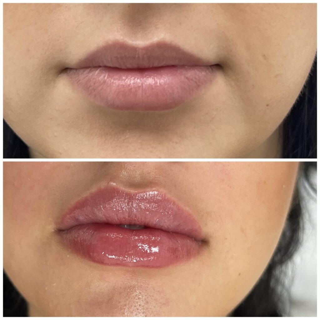 Lipfillers before and after results on a beautiful young girl
