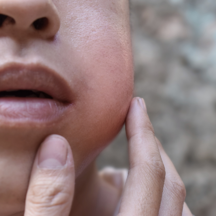 Child having an inflammation on his left cheek