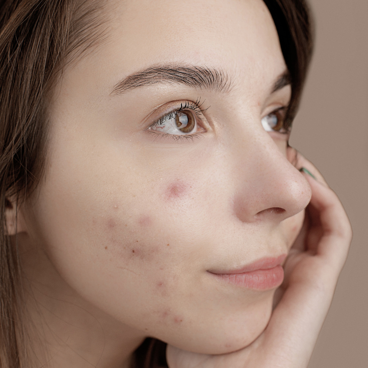 Young woman showing pimples on her face