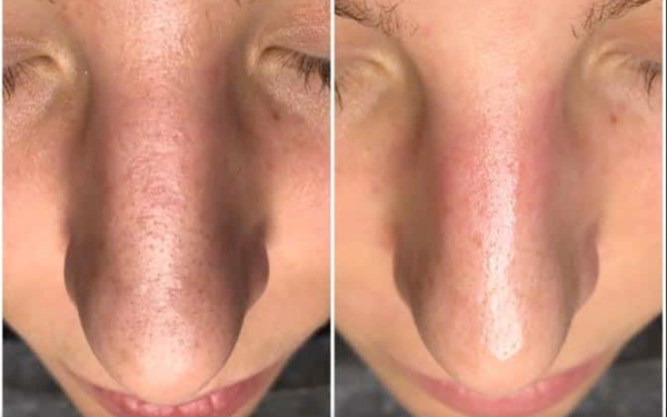 Hydrafacial behandling