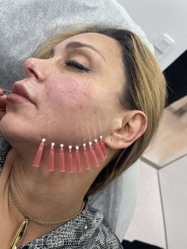 Threadlift threads on a womans face