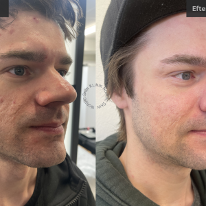 Skinboosters treatment before and after on a young man