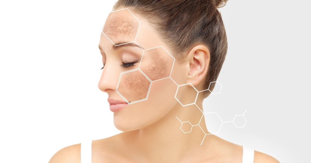 Hyperpigmentation – Treatment, Causes, and Types