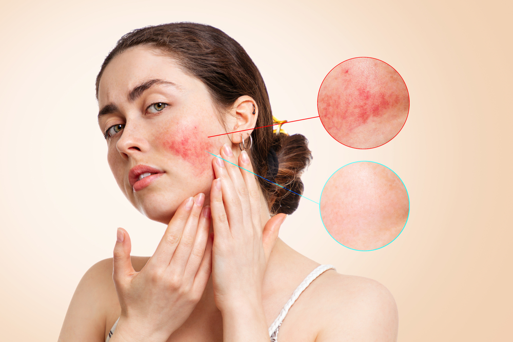 Sensitive Skin – Symptoms, Causes, Treatments