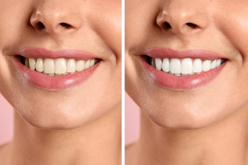 Teeth Stain: Types, Causes & How to Remove Them