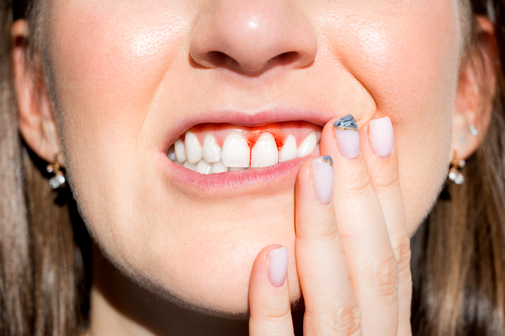 Bleeding Gums: Causes, symptoms & treatments