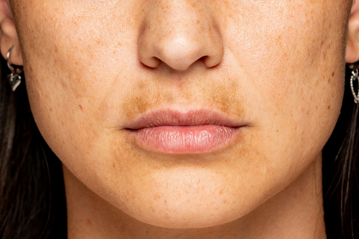 Skin Discoloration: Causes, and Treatment