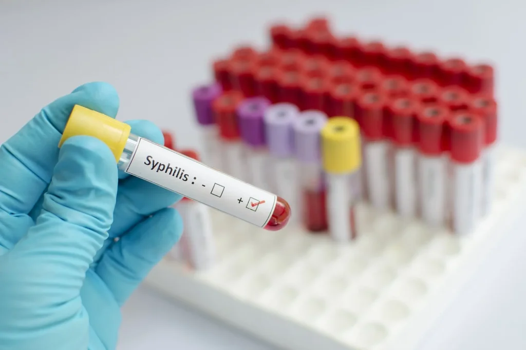 Everything You Need to Know About Syphilis