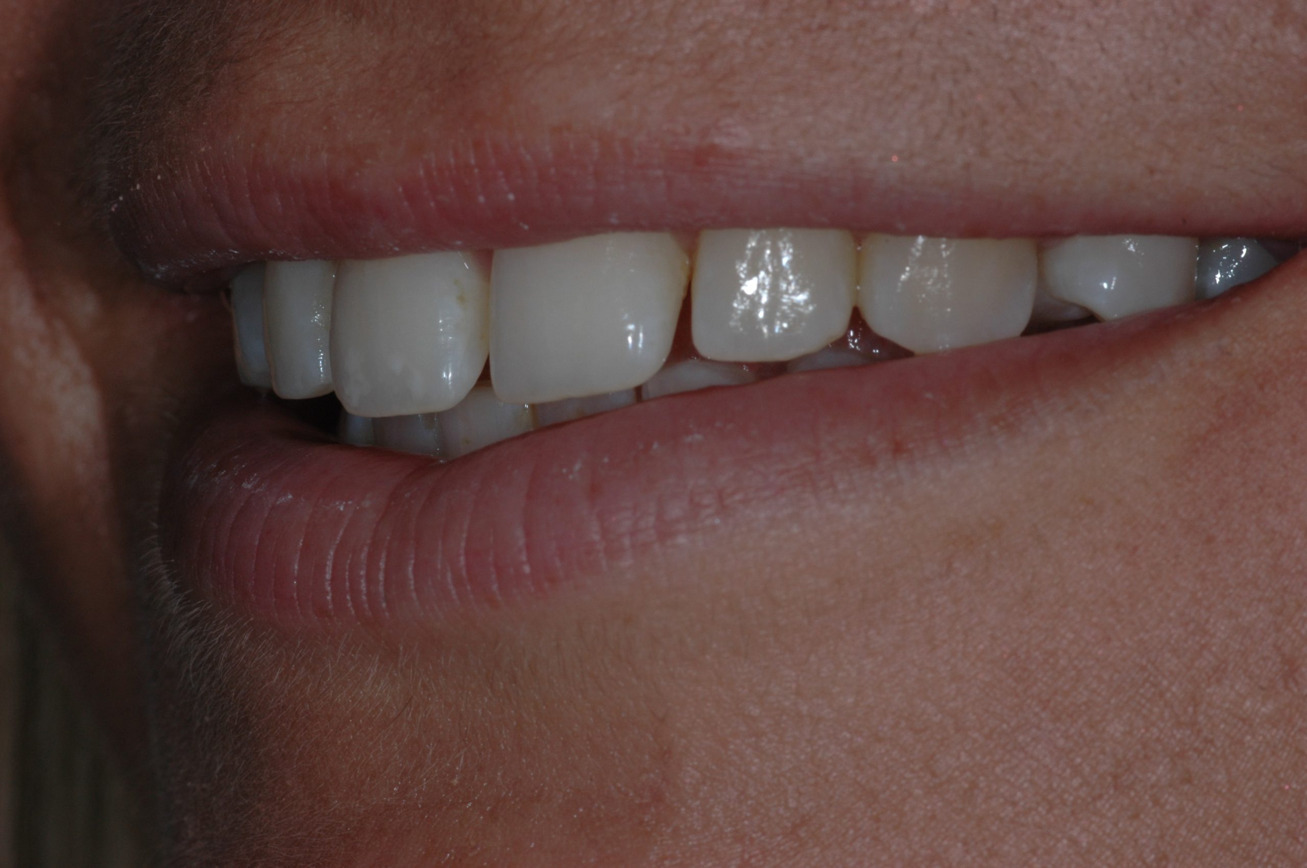 Før kosmetisk behandling Odense Dental Klinik