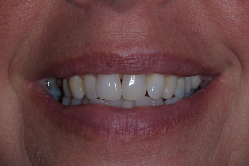 Efter Tandblegning Odense Dental Klinik