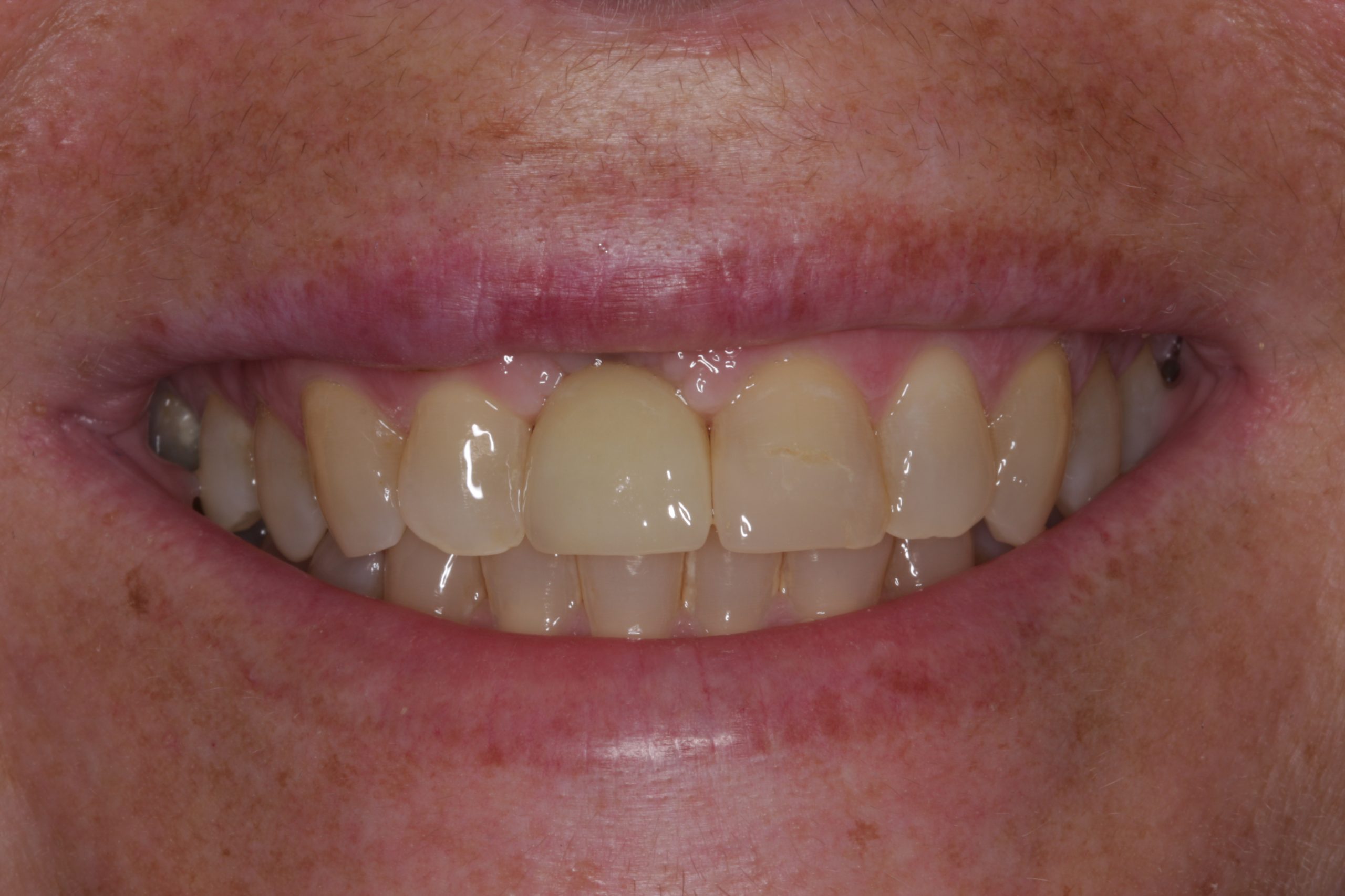 Efter tandimplantat Odensde Dental Klinik